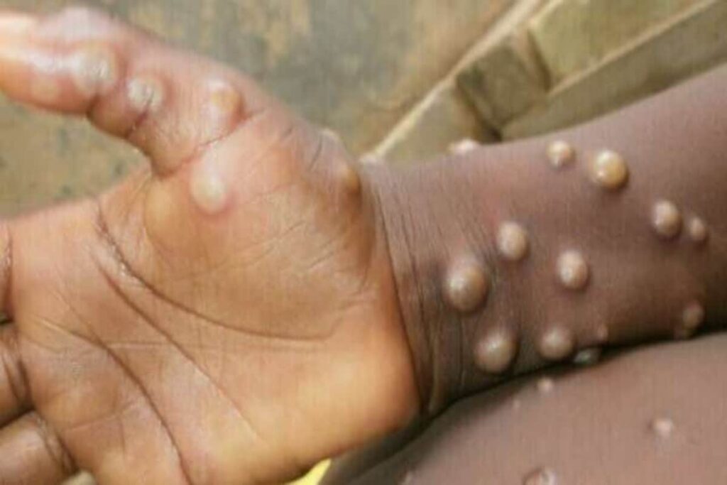 Monkeypox could be declared ‘Emergency of International Concern’