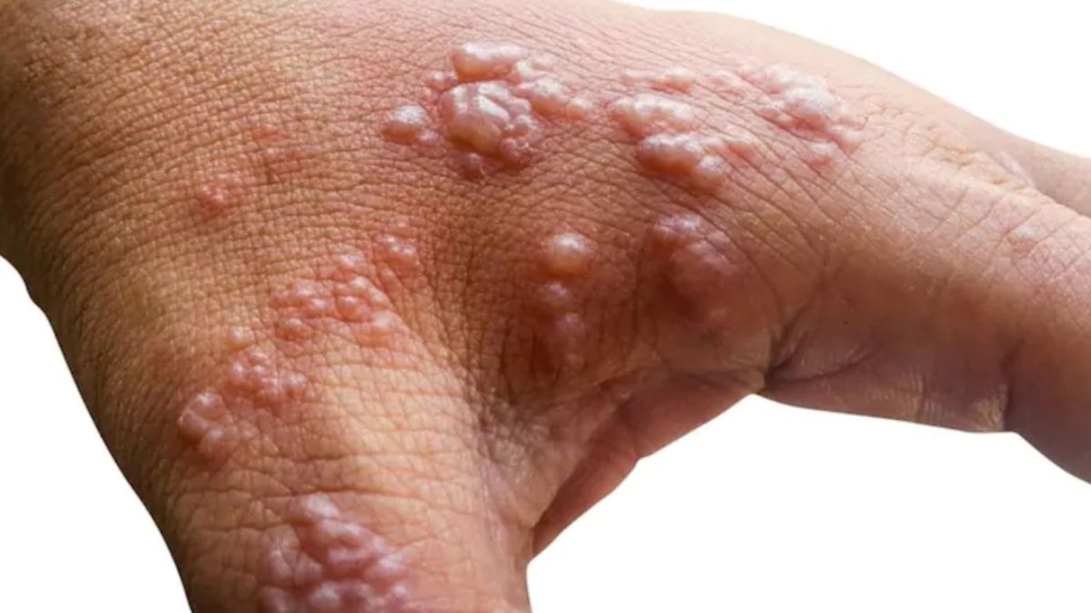 Mauritius probing first three suspected cases of monkeypox