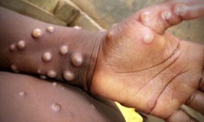 WHO declares Monkeypox a global health emergency