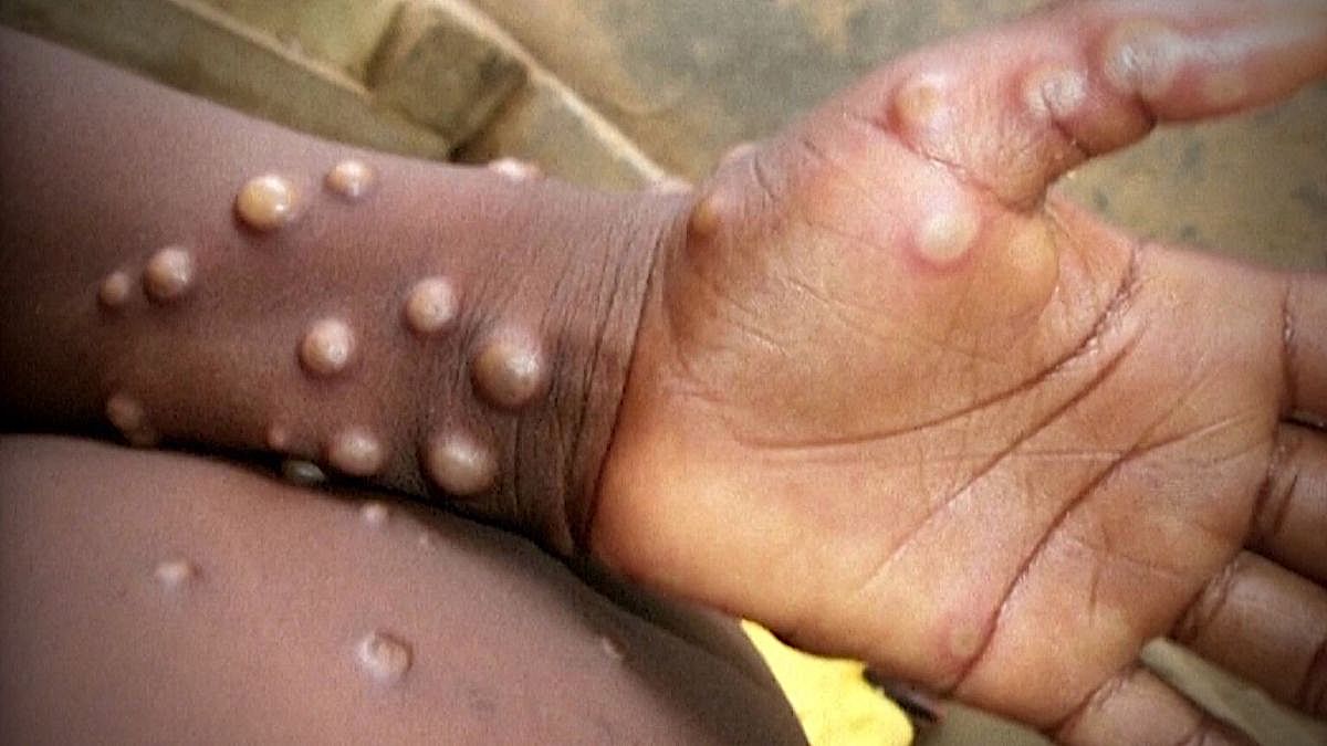 First case of Monkeypox detected in Reunion Island, Mauritius on high alert