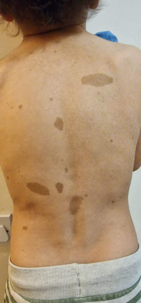 Parents warned to look out for 'cow spots' after boy, 5, diagnosed with brain tumour