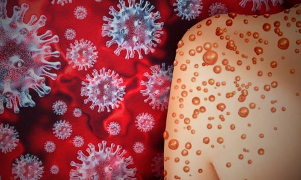Discovery of New Mpox Strain in Congo (DRC) Sparks Global Alarm