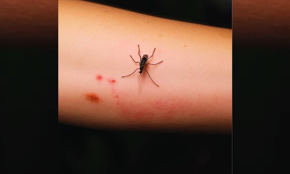 Rising Cases: 12 Dengue, 13 Chikungunya Infections Confirmed