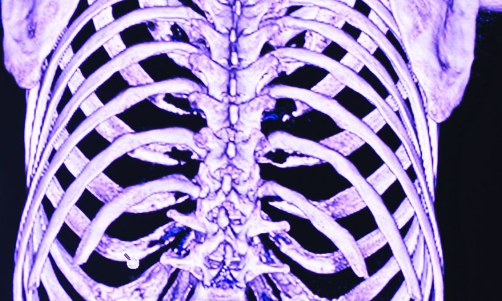 SSRN Hospital: 68-Year-Old’s 4 Fractures Ignored Twice by Doctors