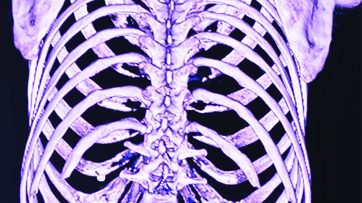 SSRN Hospital: 68-Year-Old’s 4 Fractures Ignored Twice by Doctors