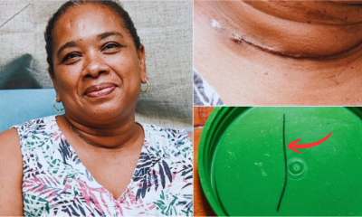 Doctors Track 24mm Wire Wedged between Vital Neck Arteries to Save Mauritian Patient